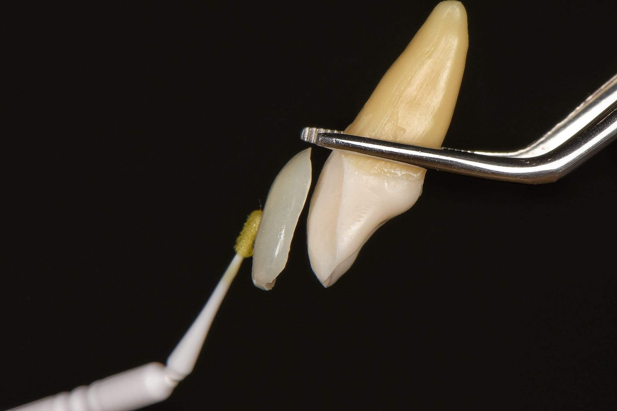 什麼是牙齒貼片？先搞懂它在做什麼