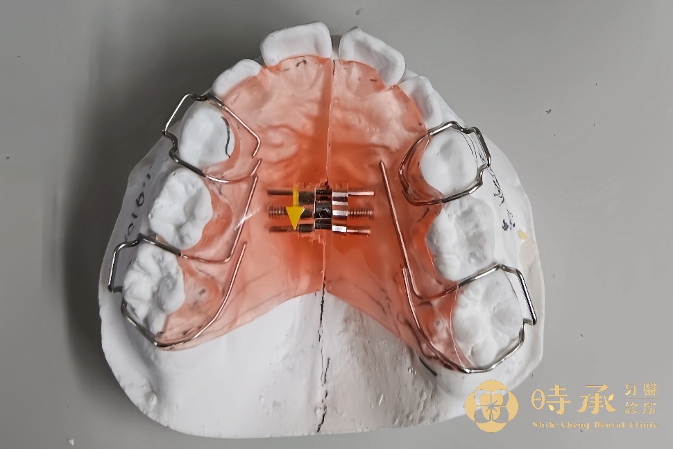 兒童矯正種類大對決：MRC、隱適美、傳統矯正怎麼選？