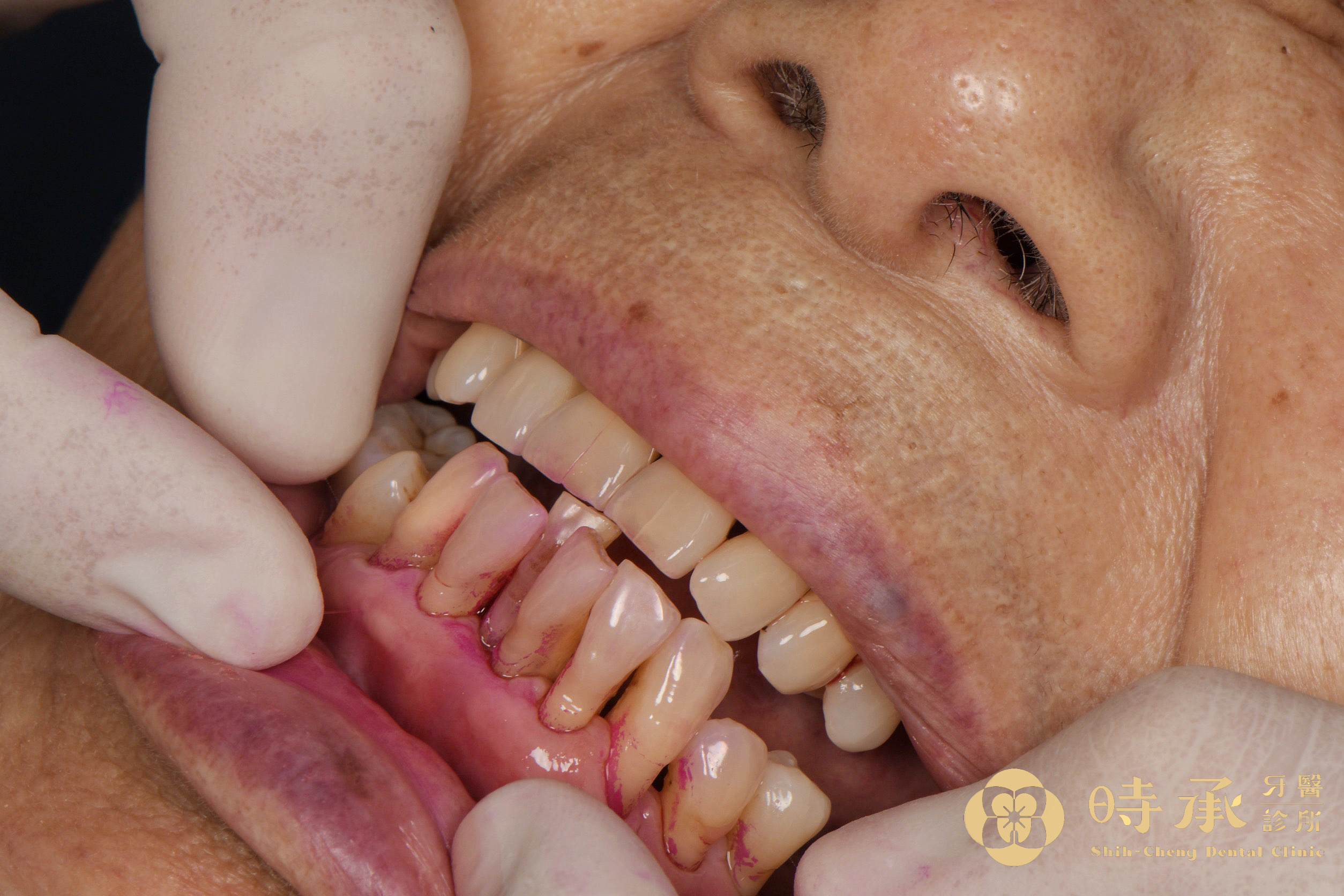 真實案例分享：從牙齒嚴重搖動到恢復大口吃肉