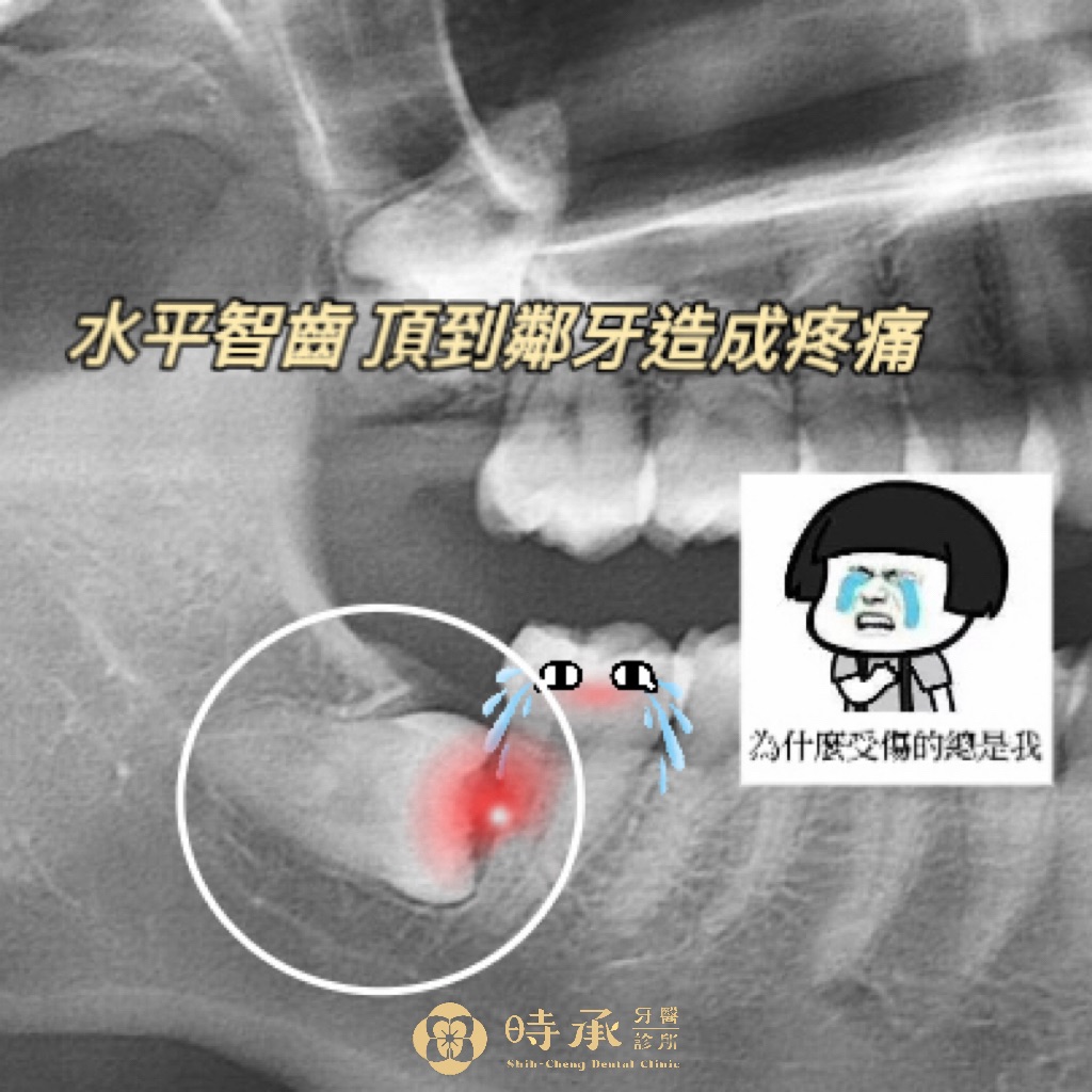 不拔智齒會怎樣