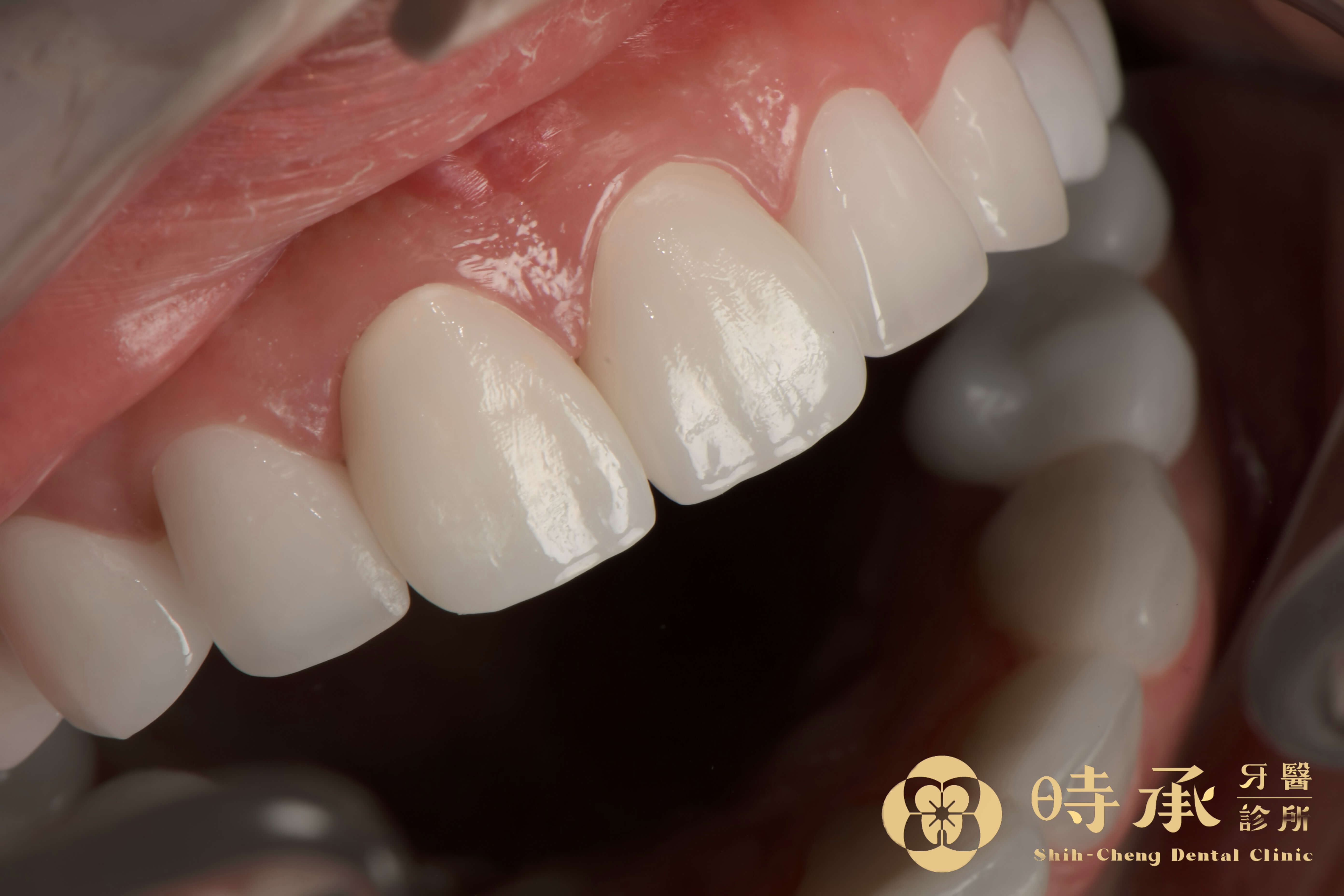 牙齒變白後要如何保養