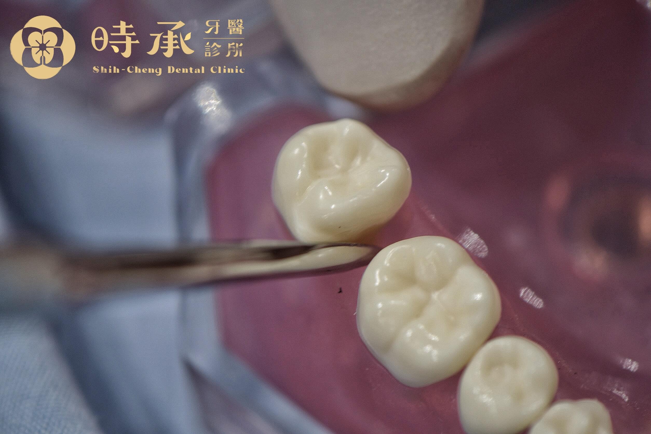 拔智齒最佳年齡與時間點