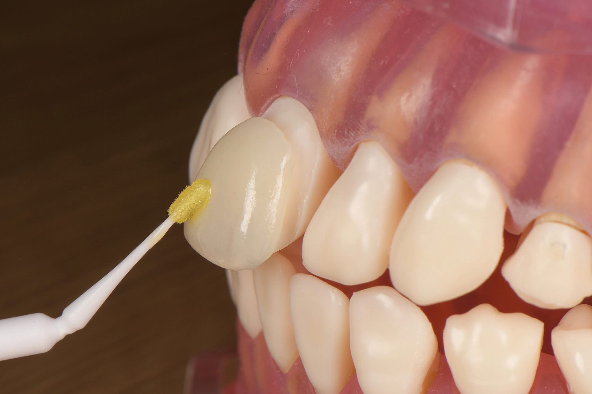 牙齒貼片價格多少？影響費用的6大關鍵