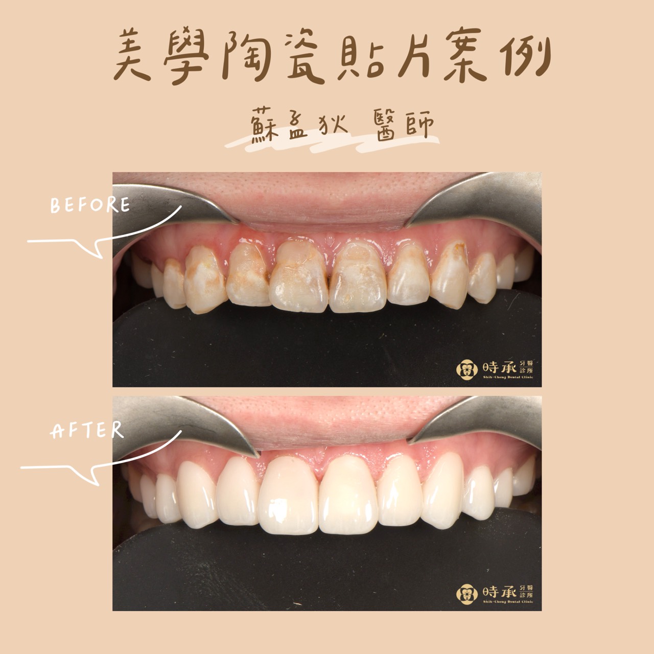 【陶瓷貼片案例】屏東20歲大學生的笑容改造：5-5陶瓷貼片