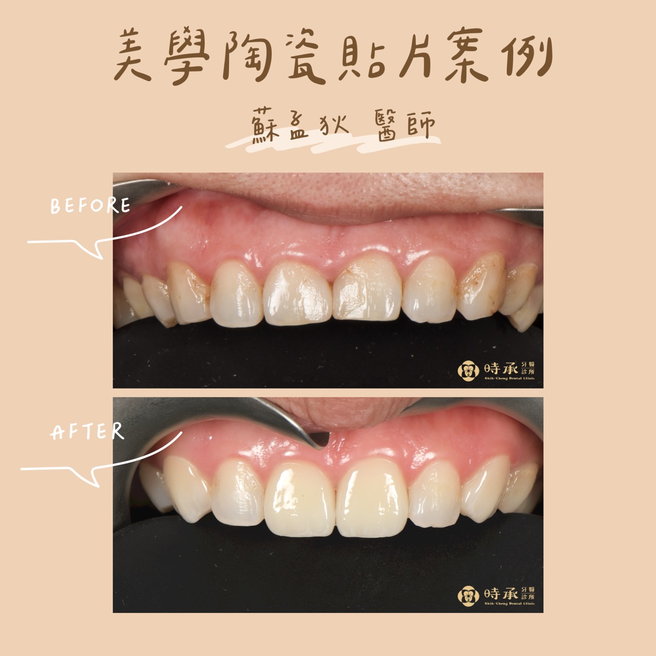 【陶瓷貼片案例】四顆貼片修飾短胖門牙,笑容更修長大方