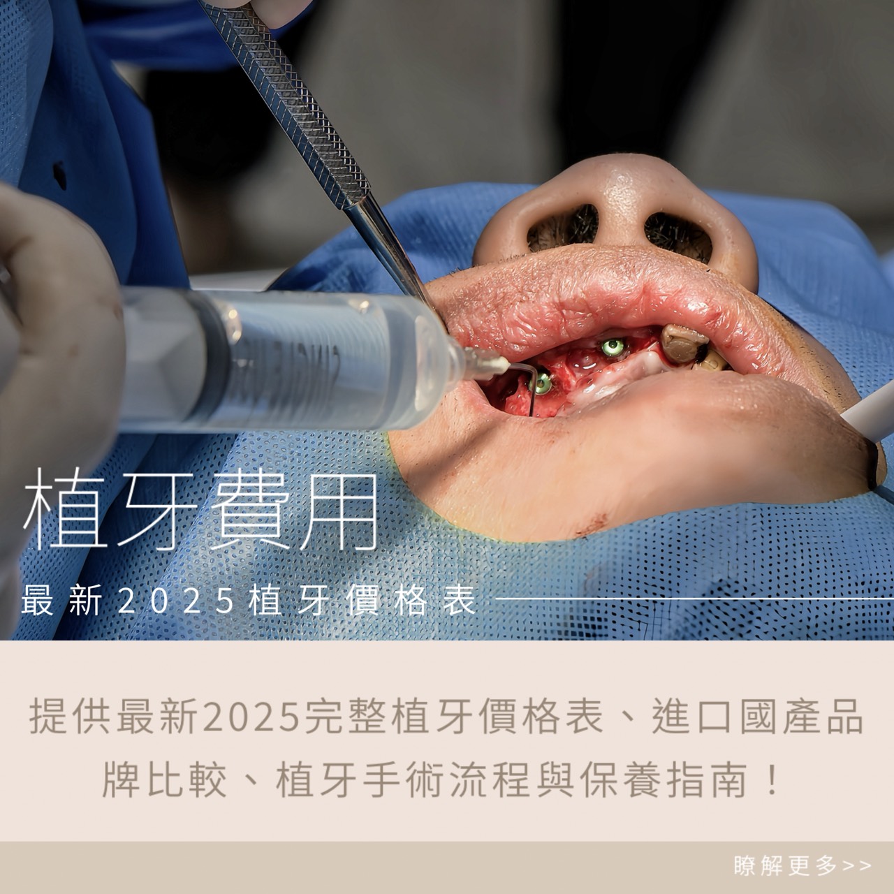 高雄植牙推薦-最新2025植牙價格表與一顆植牙費用完整解析