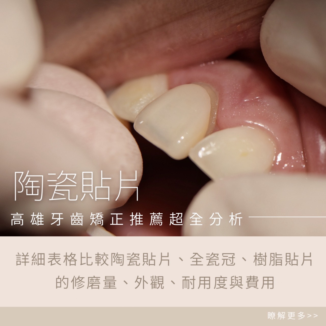 陶瓷貼片-高雄牙齒矯正推薦全分析
