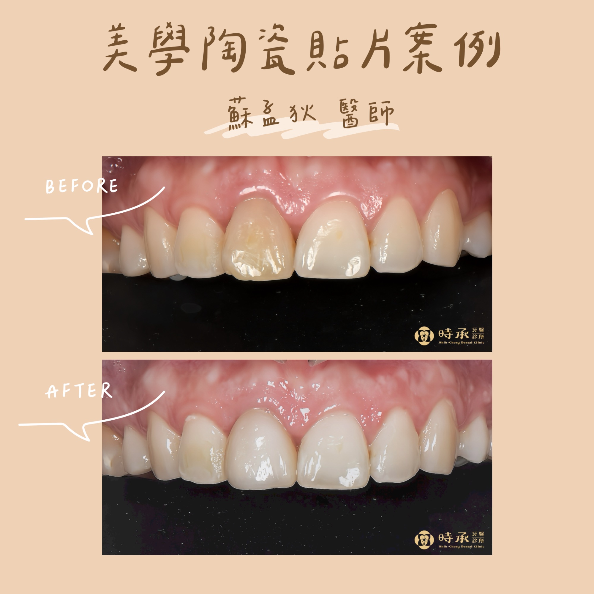 【陶瓷貼片案例】單顆陶瓷貼片改善門牙染色