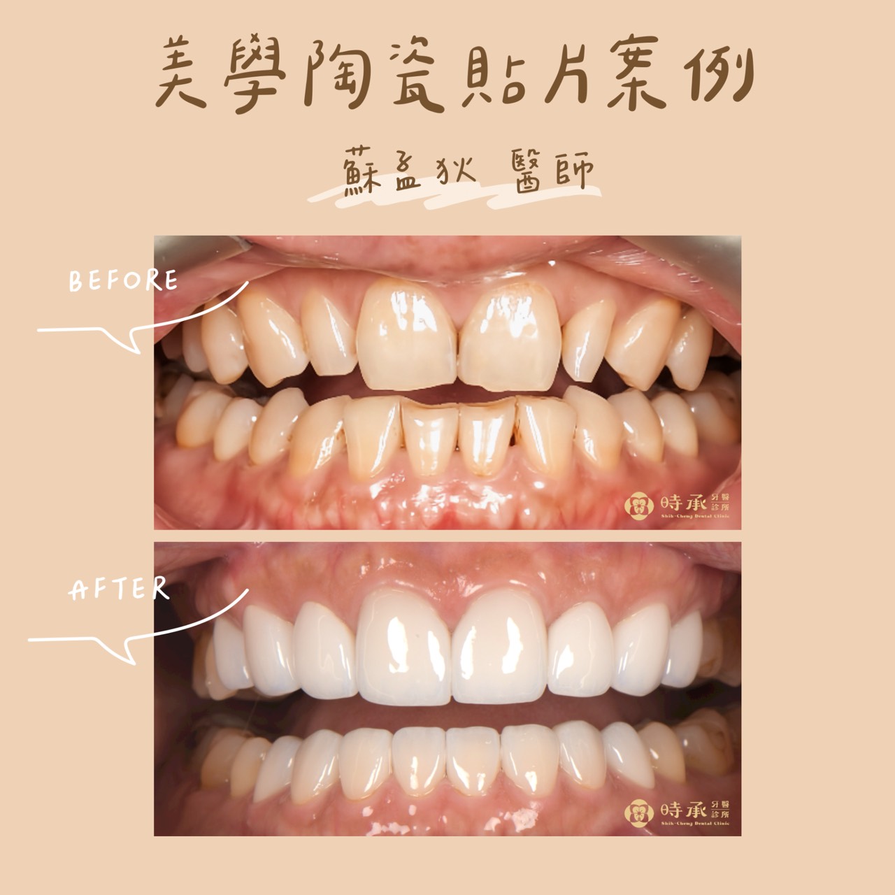 【陶瓷貼片案例】上下各8顆貼片，打造專業氣質笑容