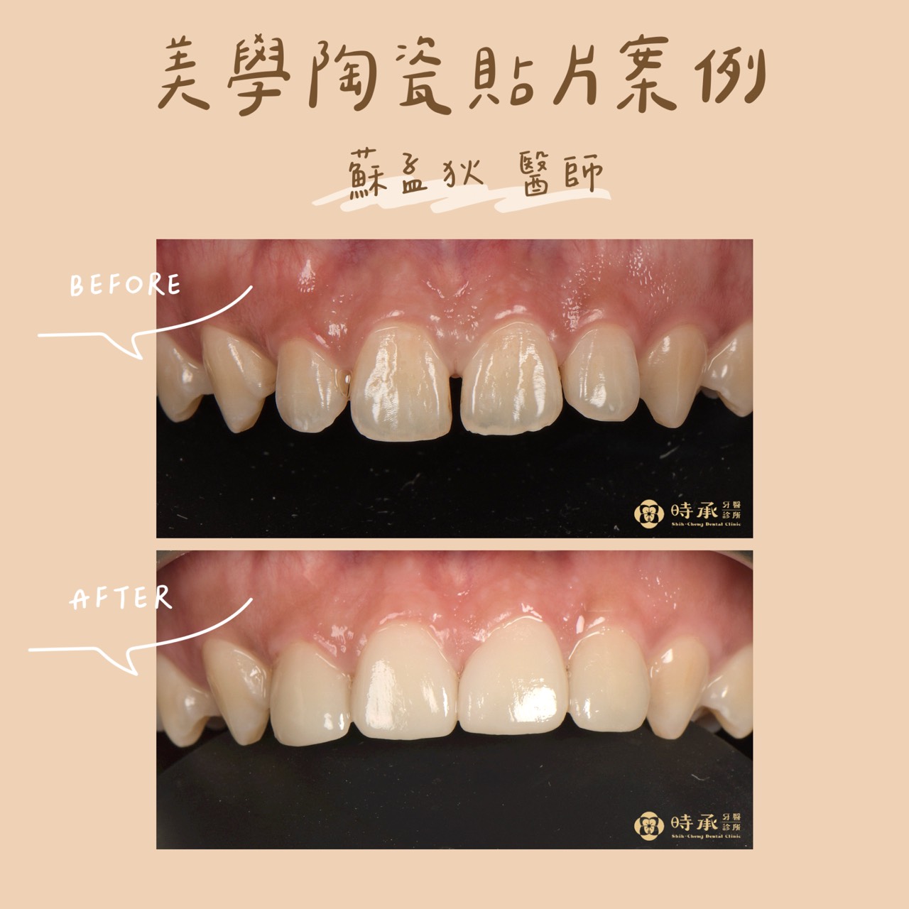 【陶瓷貼片案例】四顆貼片重塑門牙比例，擺脫牙縫困擾