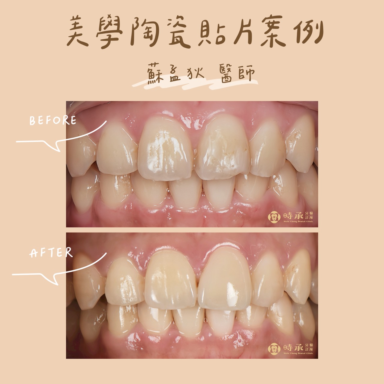 【陶瓷貼片案例】改善門牙缺角和瑕疵困擾，重現自然光澤笑容
