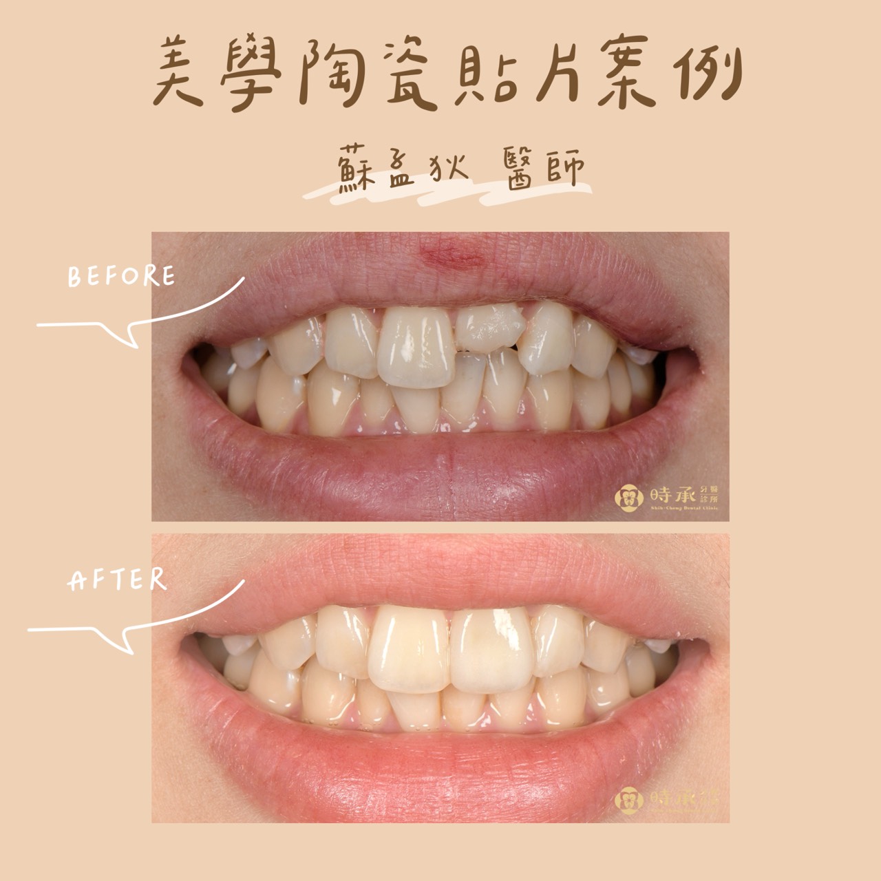【陶瓷貼片案例】從意外斷牙到重拾笑容自信