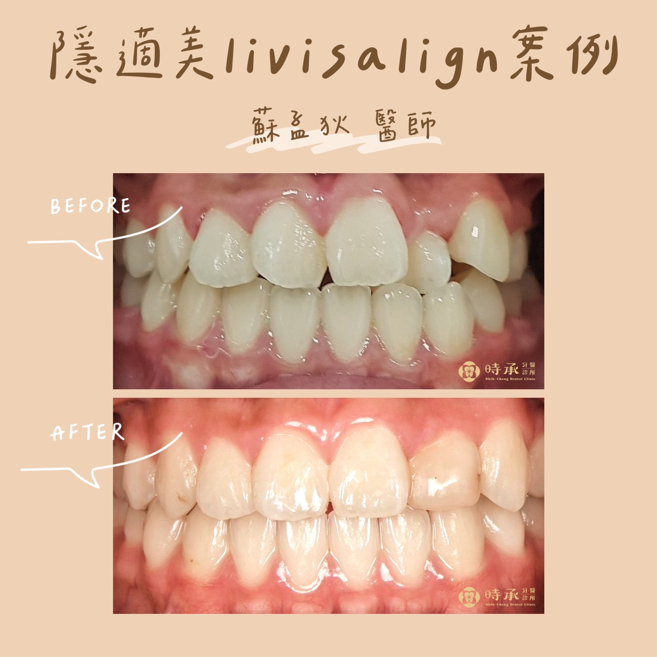 【隱適美矯正案例】17歲排球選手的隱適美矯正之路