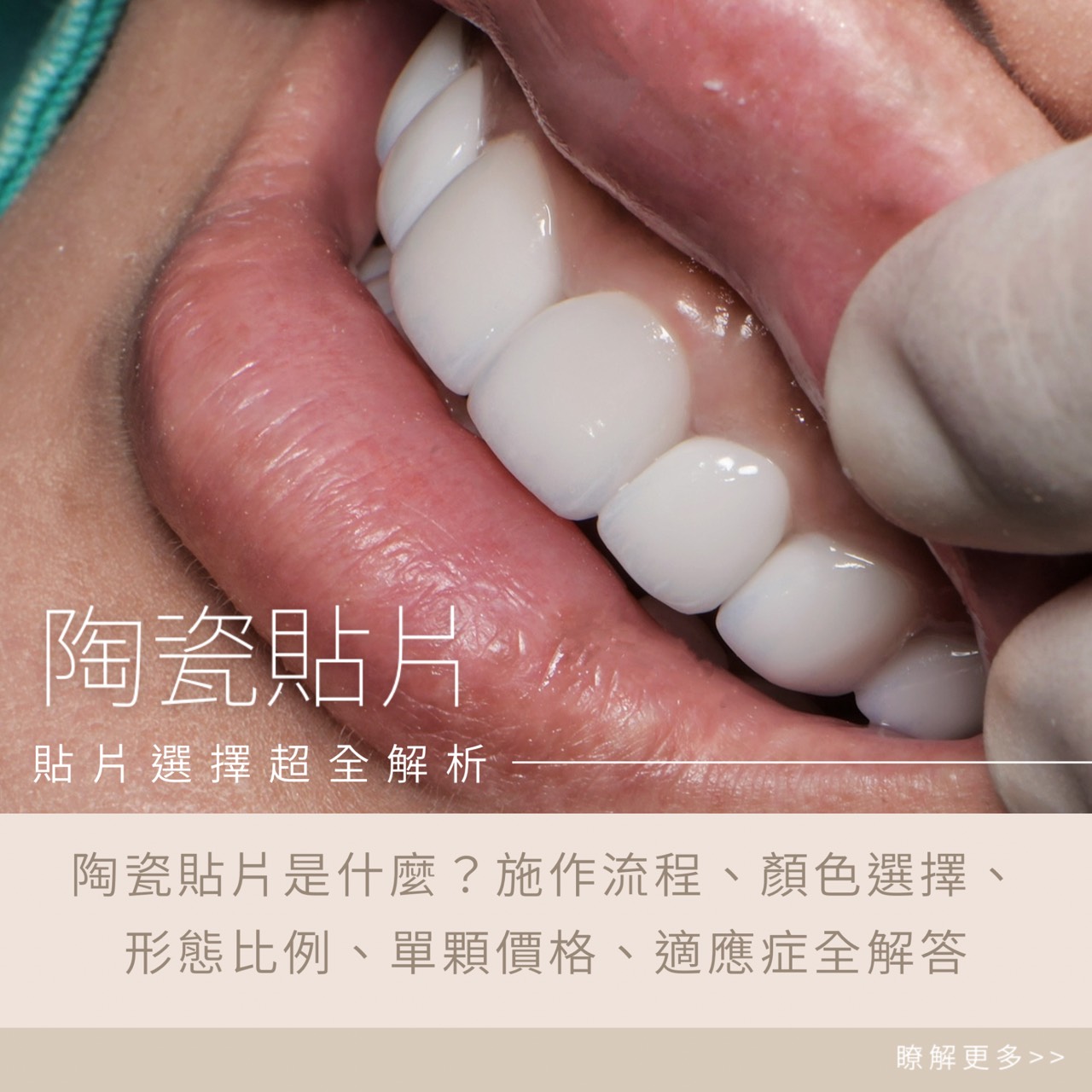 陶瓷貼片全攻略：價格、施作流程、選色型態一次看懂-時承牙醫診所