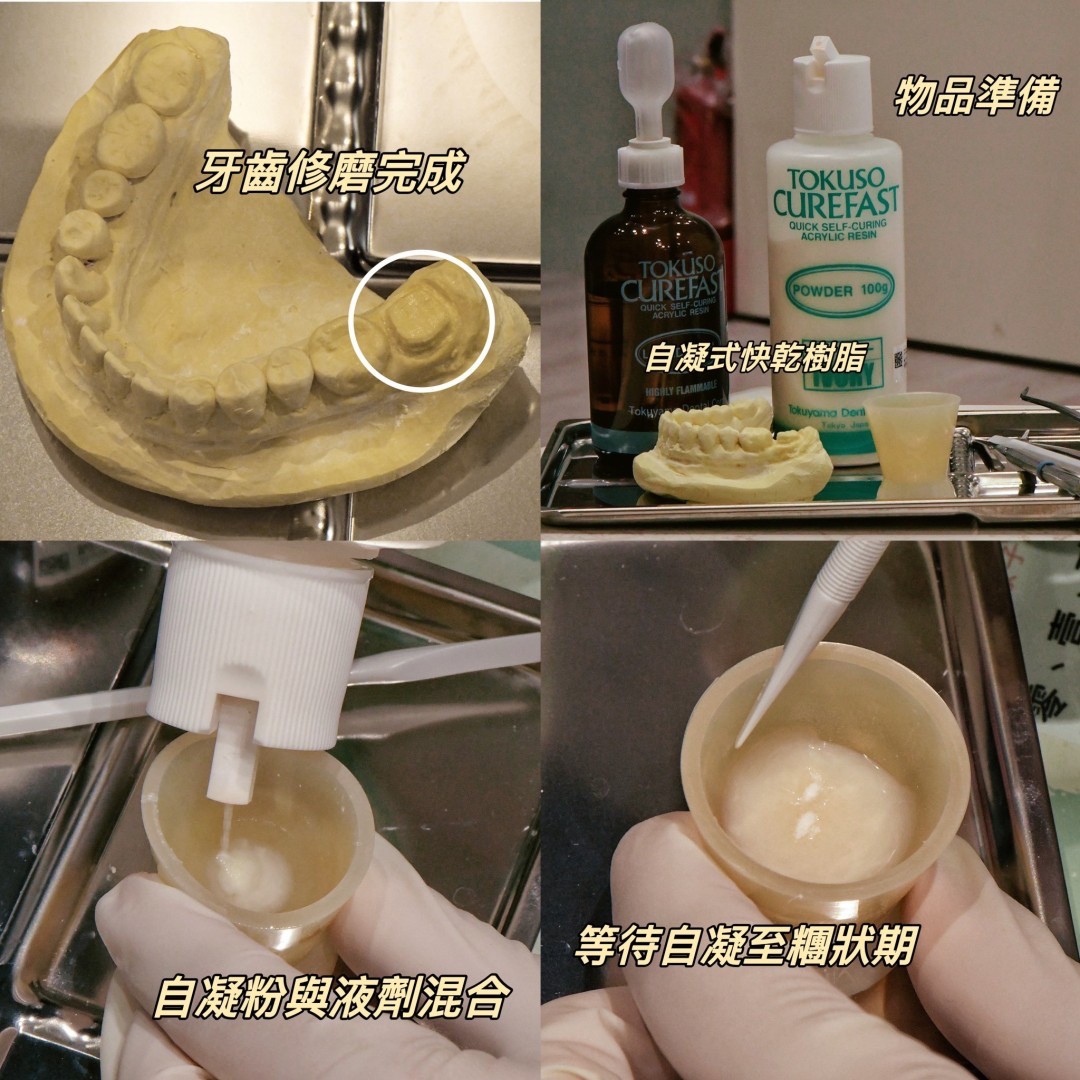 窩溝封填｜封填流程｜能維持多久｜給付對象