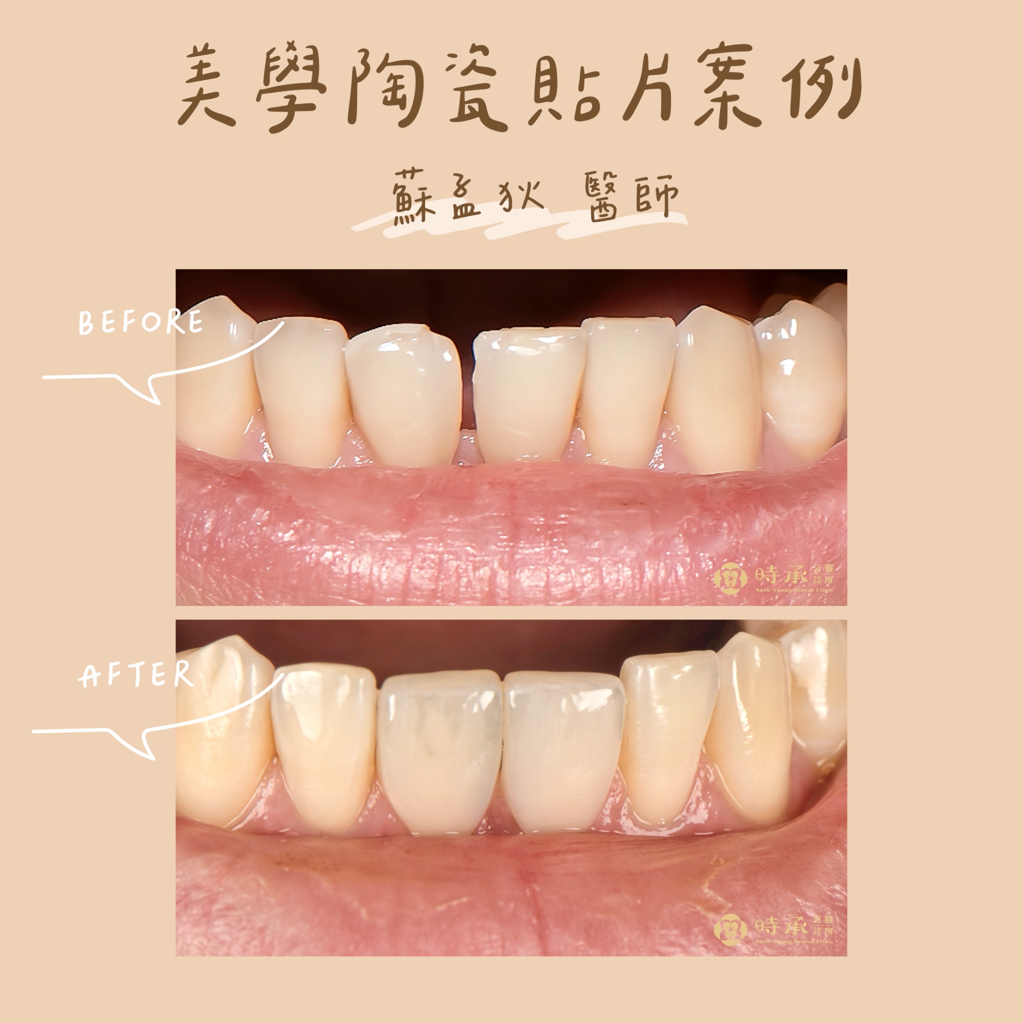 【陶瓷貼片案例】兩顆陶瓷貼片精準改善下排牙縫，打造自然整齊微笑線