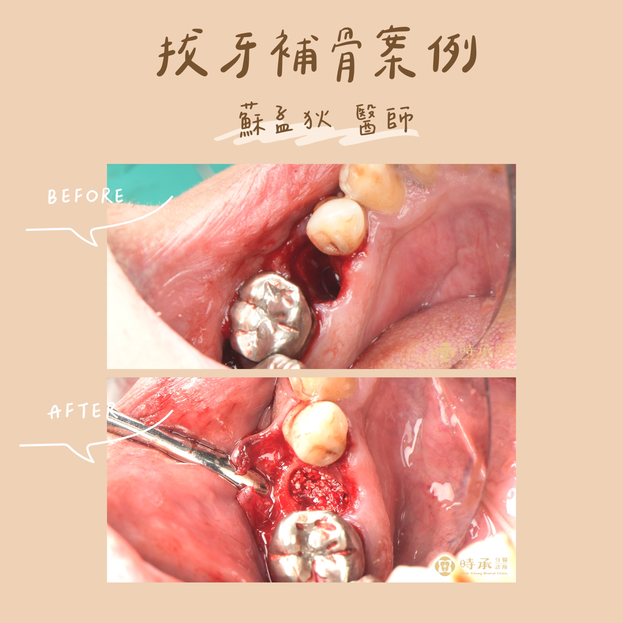 【拔牙補骨案例】拔牙同時補骨，防止齒槽骨流失