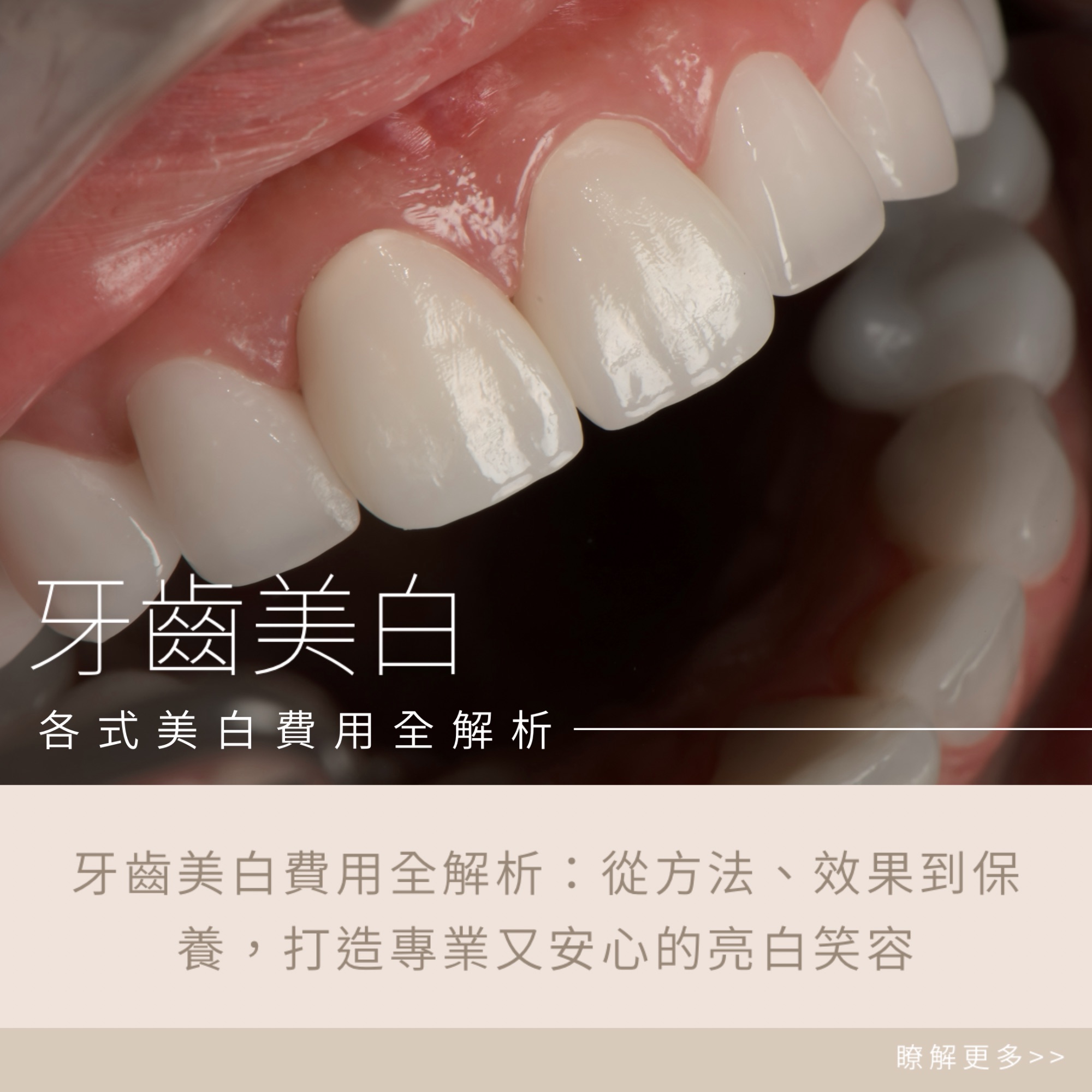 牙齒美白費用全解析：從方法、效果到保養，打造專業又安心的亮白笑容