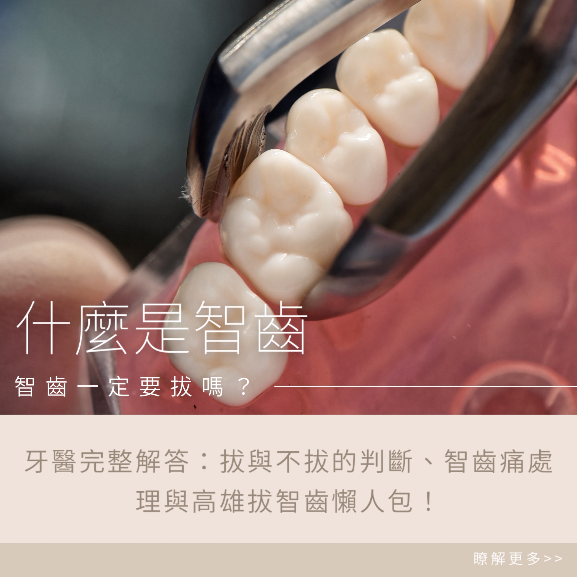 智齒一定要拔嗎?牙醫完整解答:拔與不拔的判斷、智齒痛處理與高雄拔智齒懶人包