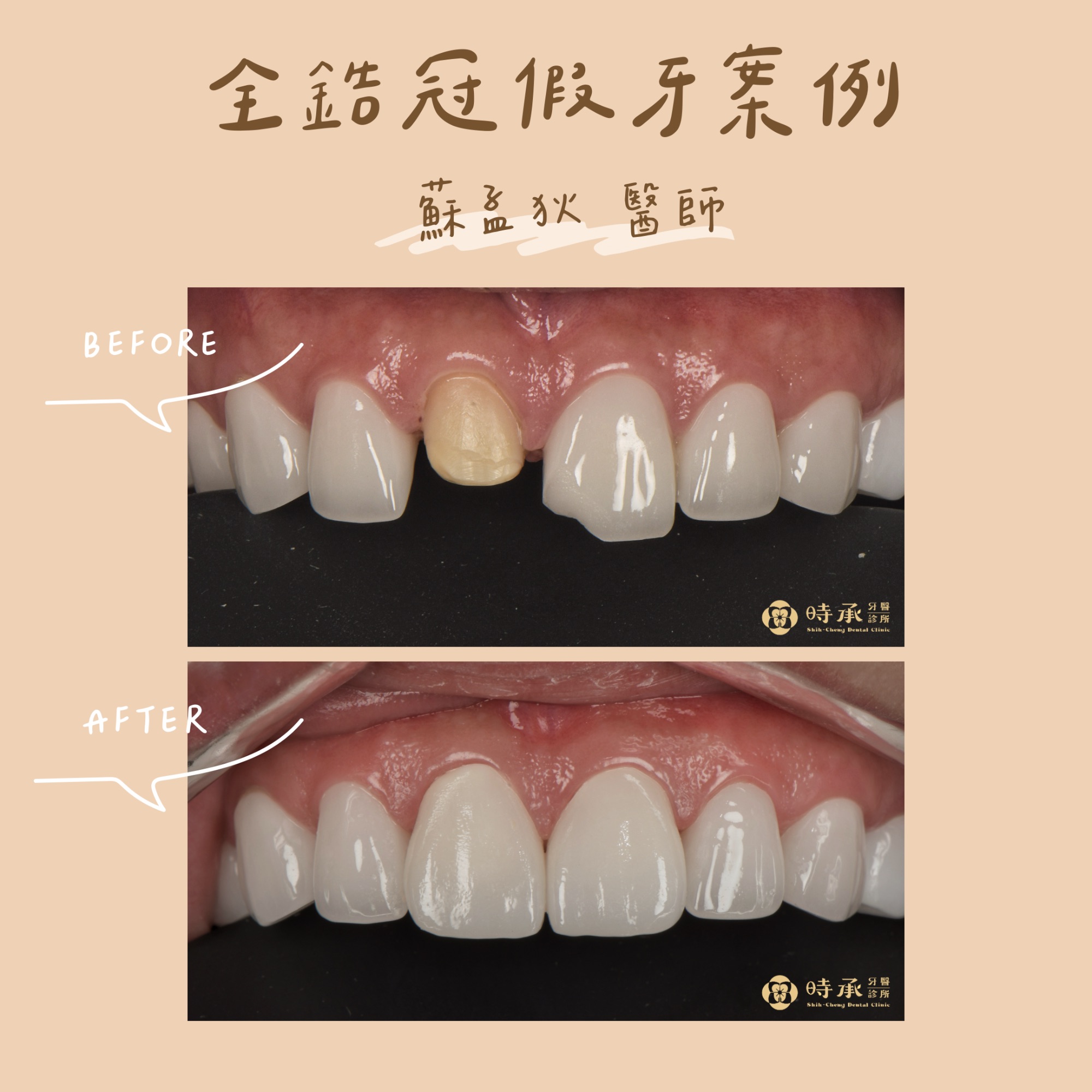 【全鋯冠假牙案例】假牙斷裂重建自然笑容，兩顆全瓷冠讓門牙重拾亮白與自信