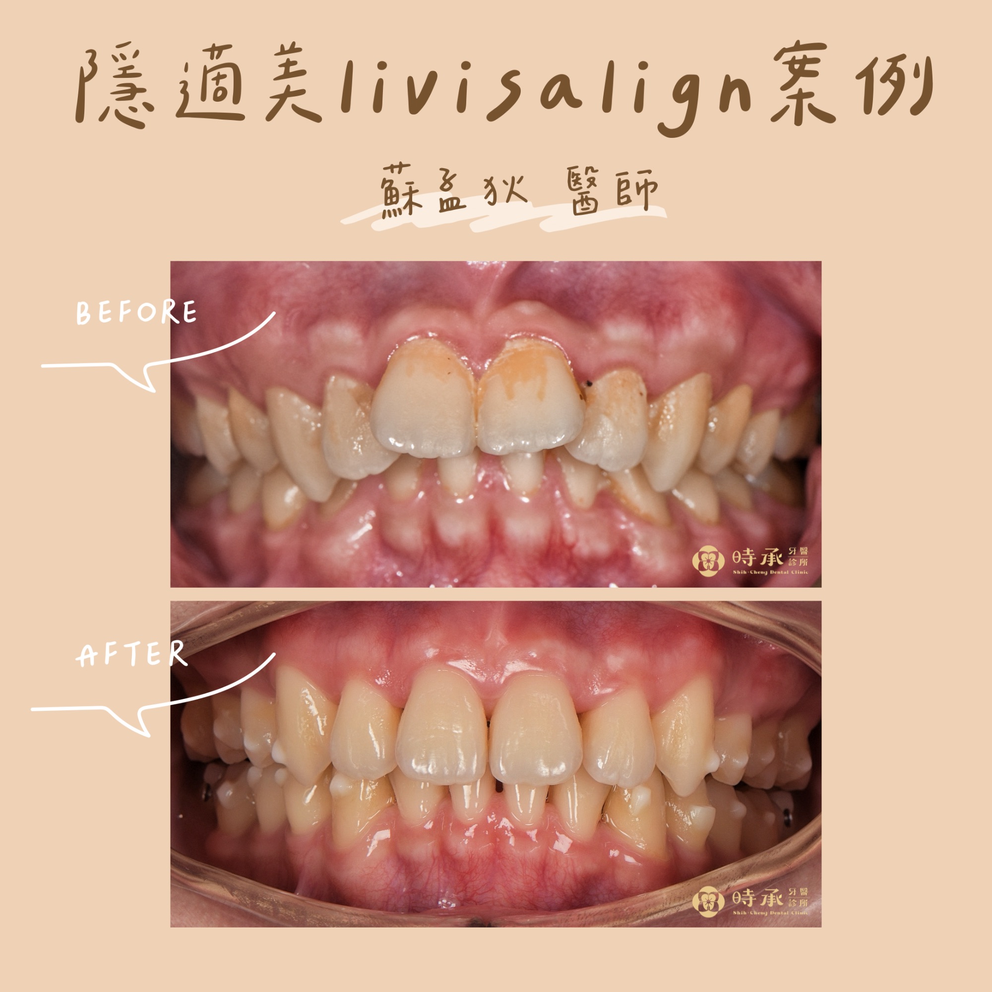 【隱適美矯正案例】17歲高中生隱適美矯正，改善暴牙曲線，找回自信笑容