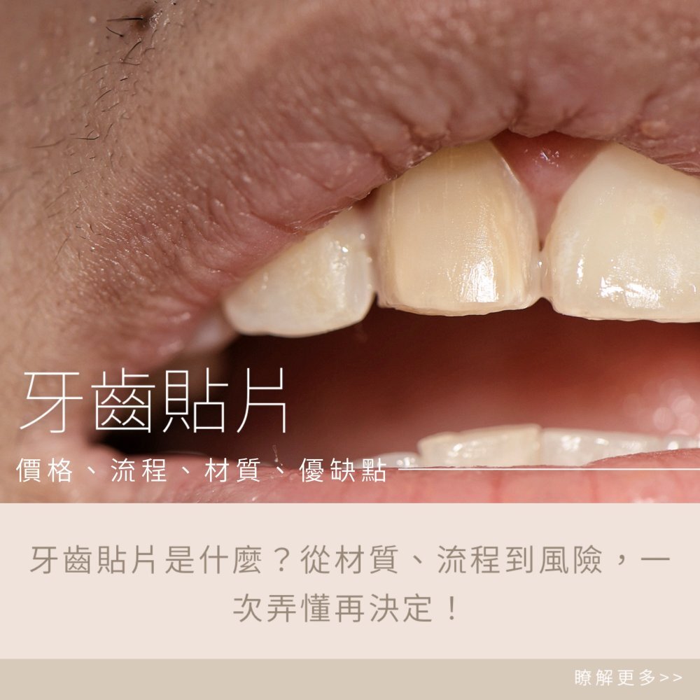 牙齒貼片價格多少？從材質、流程到風險，一次弄懂再決定