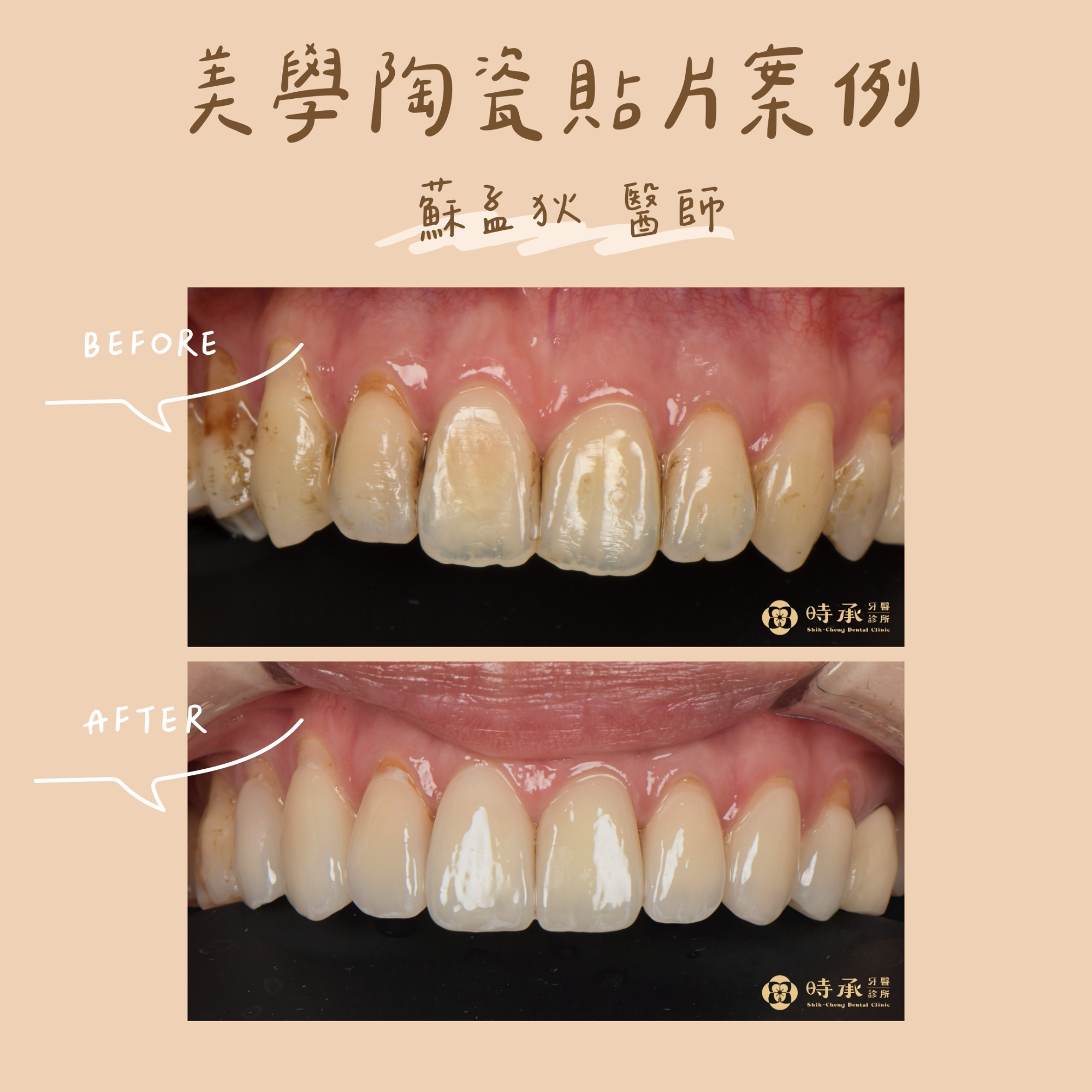 【陶瓷貼片案例】改善門牙暗沉與咬合歪斜，找回最甜笑容
