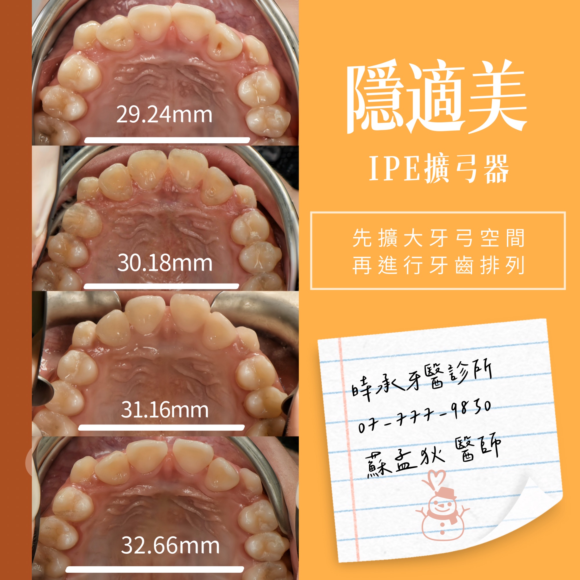 隱適美IPE|在成長期,把牙弓空間準備好