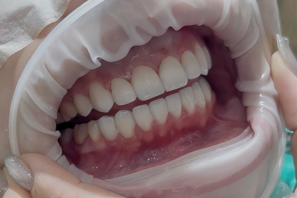 【陶瓷貼片案例】