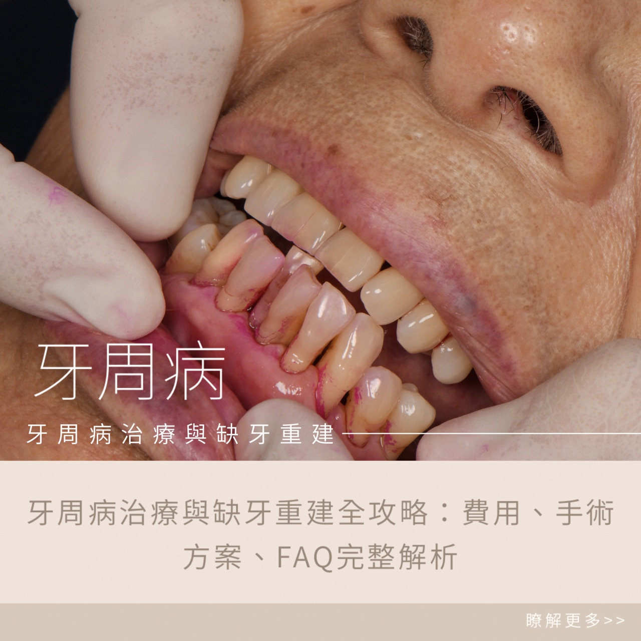 牙周病治療與缺牙重建全攻略：費用、手術方案、FAQ完整解析