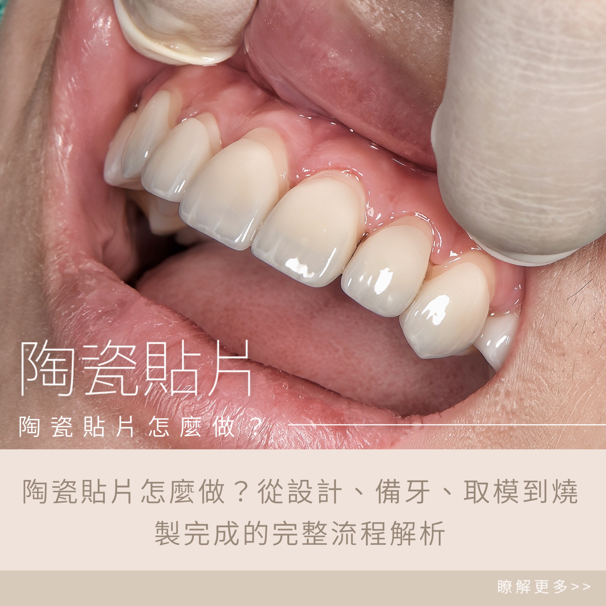 陶瓷貼片怎麼做？從設計、備牙、取模到燒製完成的完整流程解析