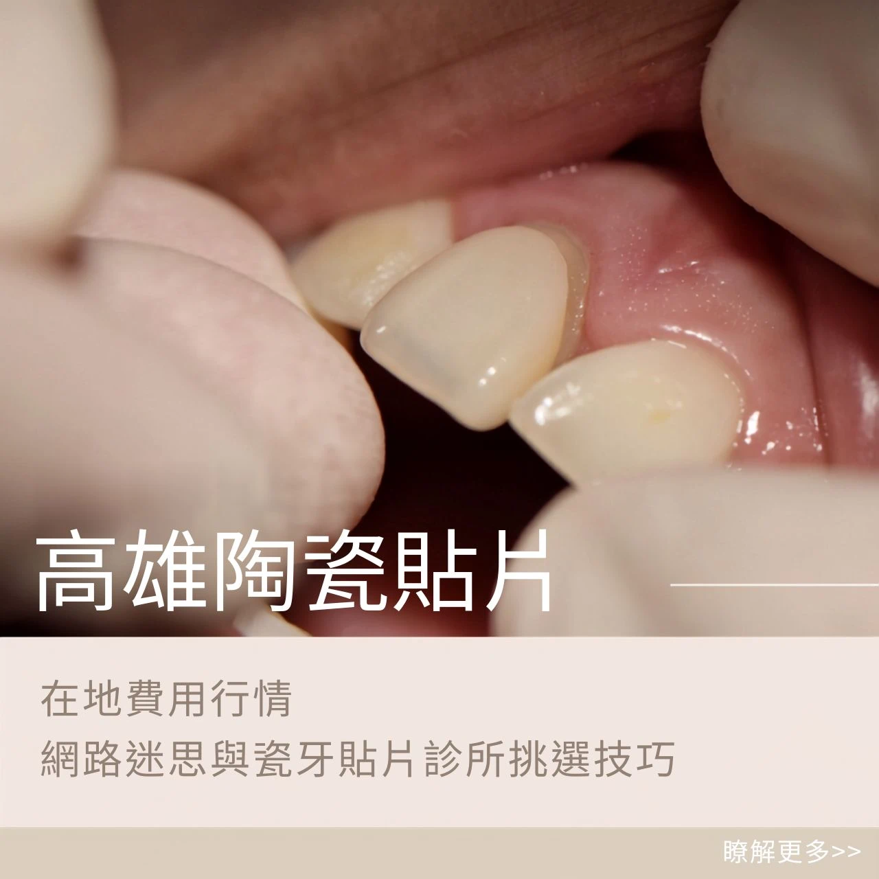 高雄陶瓷貼片全分析：在地費用行情、網路迷思與瓷牙貼片診所挑選技巧