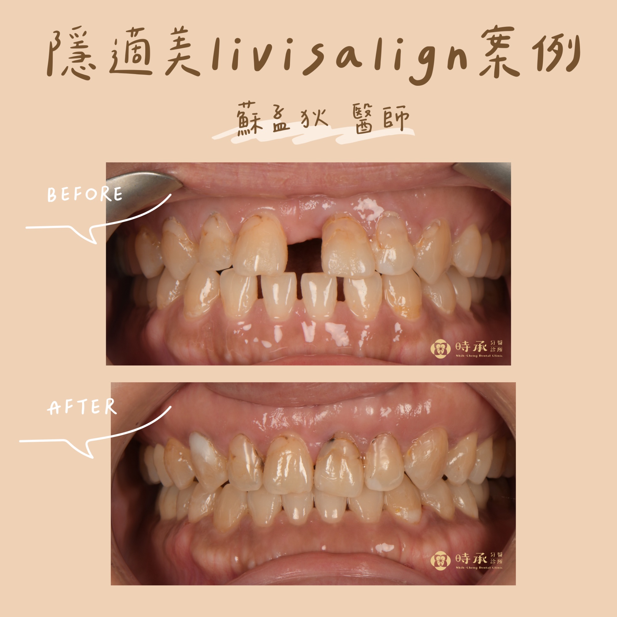 【隱適美矯正案例】國小老師矯正案例