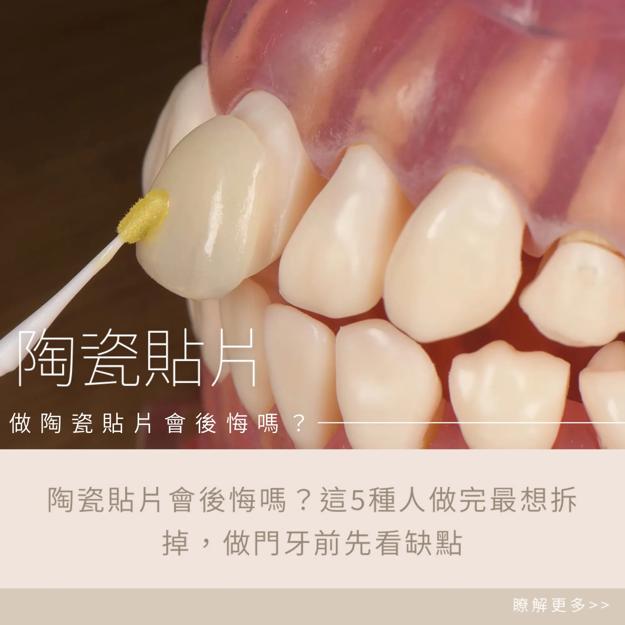 陶瓷貼片會後悔嗎？這5種人做完最想拆掉，做門牙前先看缺點