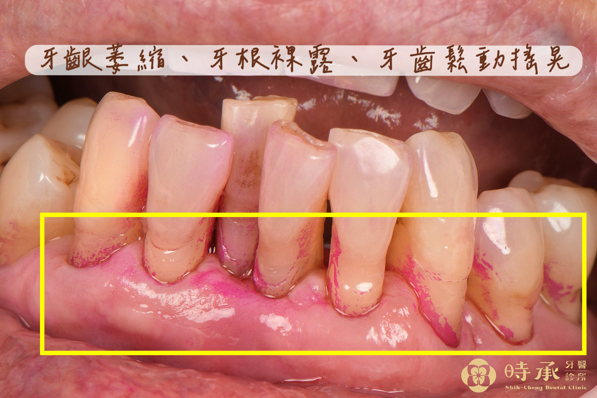 牙周病治療的核心價值與真實情境