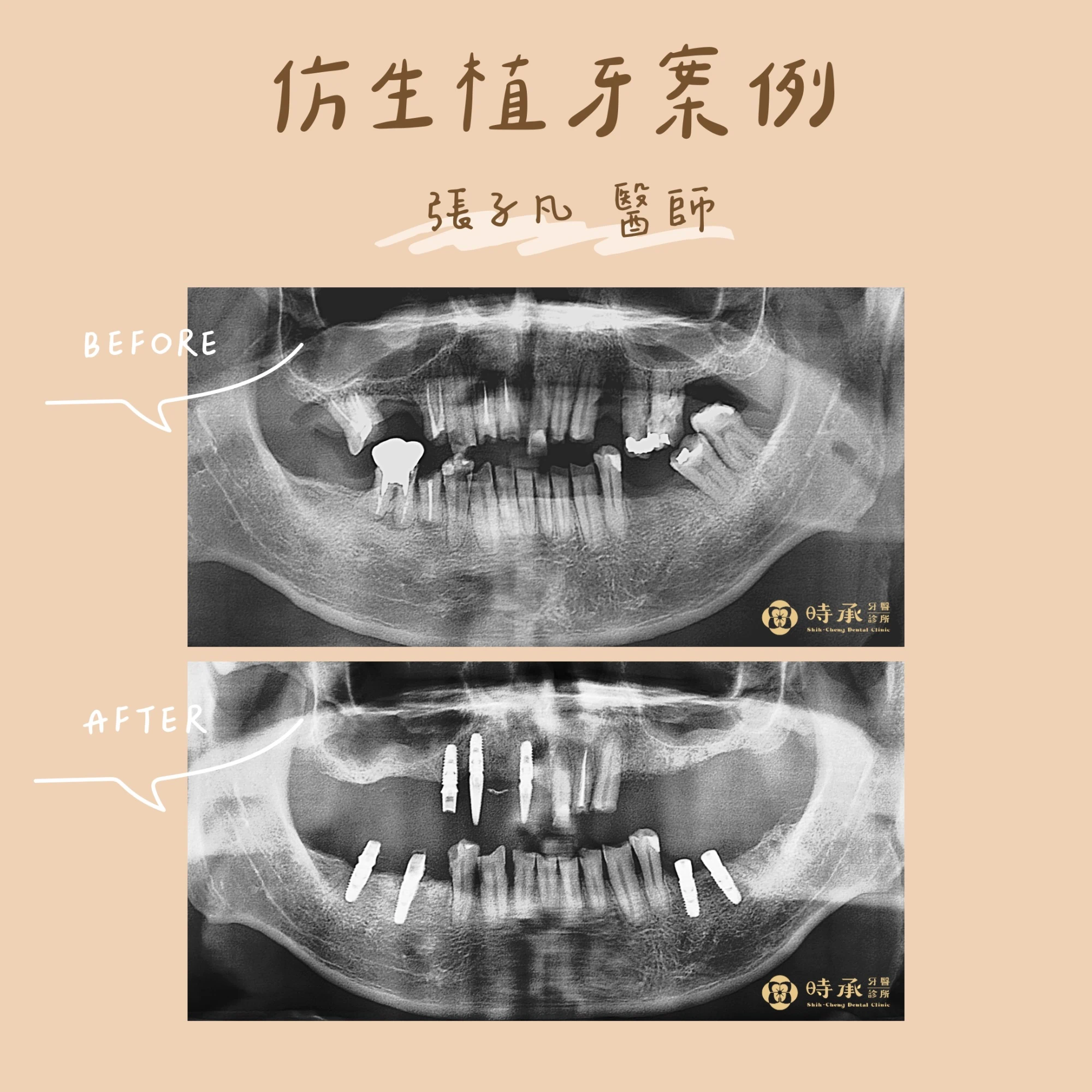 時承牙醫的仿生植牙案例