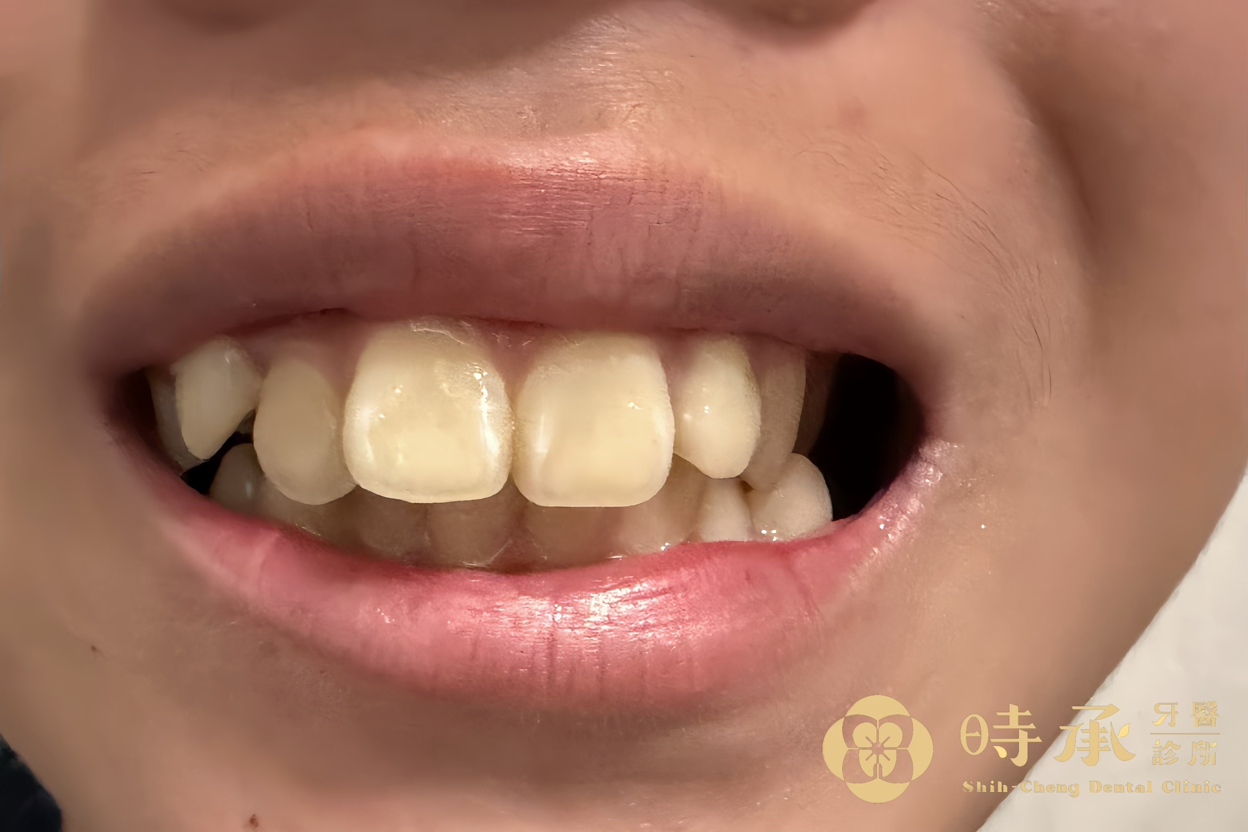 實際案例分享：從戽斗到整齊齒列的蛻變