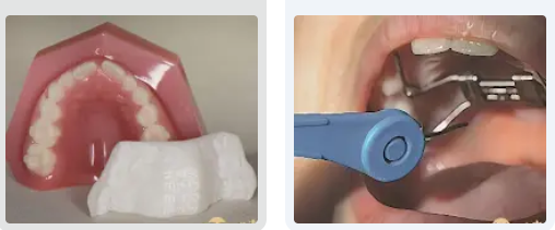 隱適美IPEvs.傳統金屬擴弓器：家長該如何選擇