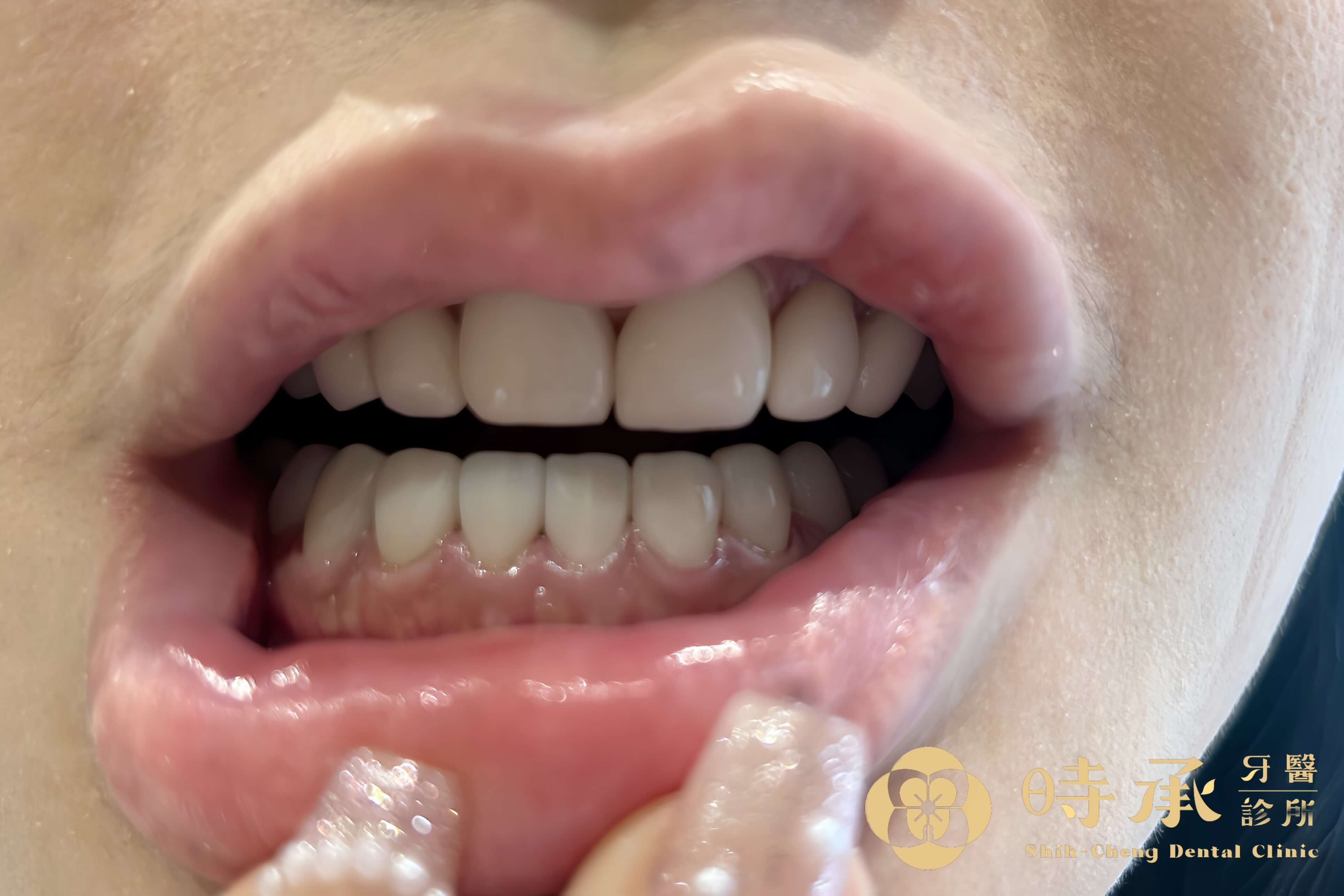 牙齒美白效果能維持多久